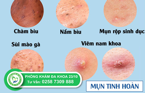 Những nguyên nhân gây ra tình trạng nổi mụn tinh hoàn