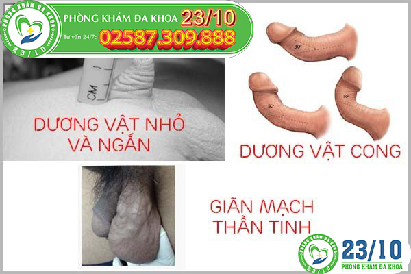 Những trường hợp phải chỉnh hình dương vật gấp