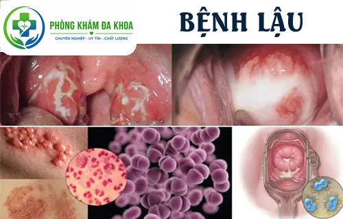 Nổi mụn ở vùng kín do bệnh lậu
