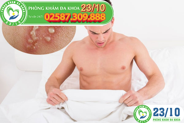 MỤN RỘP SINH DỤC DẪN ĐẾN DƯƠNG VẬT NỔI MỤN RỘP