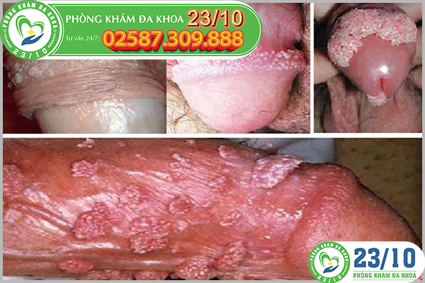 Mụn thịt ở dương vật là dấu hiệu sùi mào gà