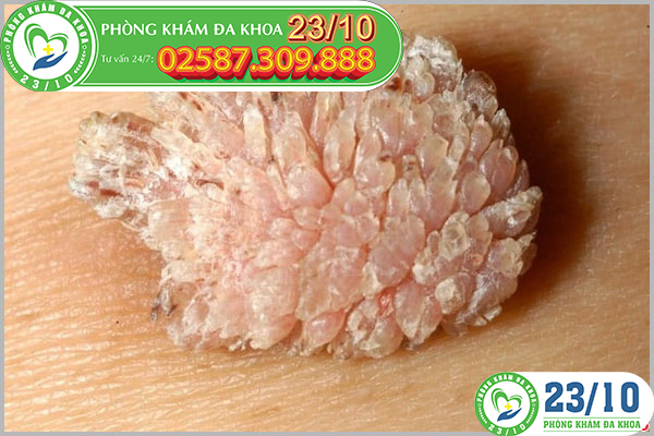 Sùi mào gà ở nam và nữ