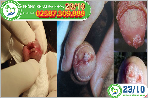 Sùi mào gà ở dương vật căn bệnh nguy hiểm