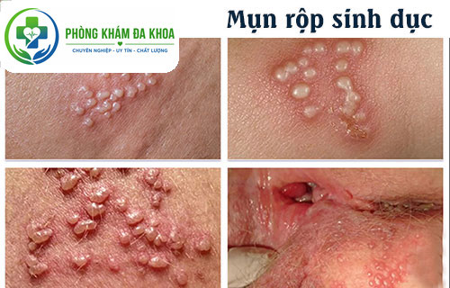 Mụn rộp sinh dục là một trong những căn bệnh hoa liễu khá phổ biến
