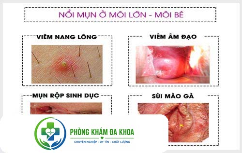 Nguy hiểm khi gặp phải tình trạng nổi hột ở môi bé